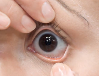 contact lens insertion